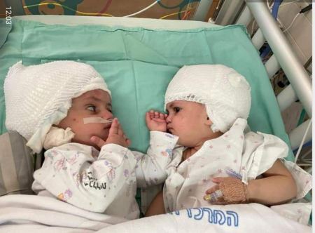 العملية الأولى من نوعها في البلاد: فصل توأمتين ولدتا برأسين ملتصقين